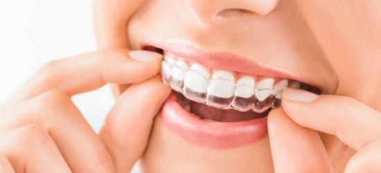 $150 National Online Focus Group About Invisalign, EverSmile, etc.