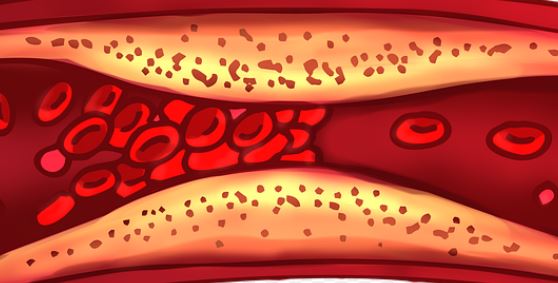 $75 National Online Study About Blood Clots